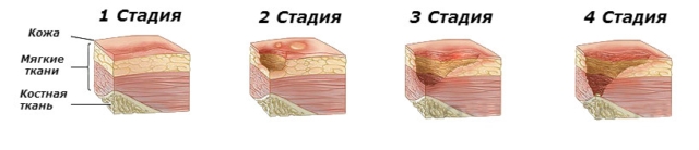 Язва трофическая отеки тела