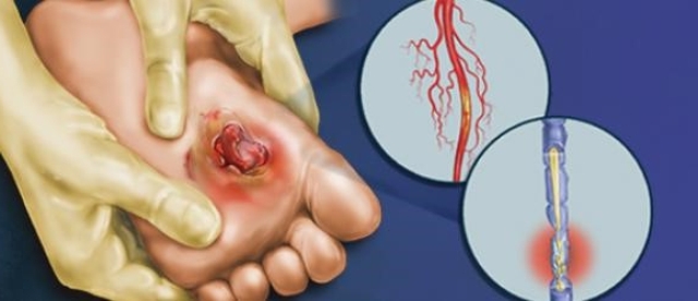 Язва трофическая отеки тела